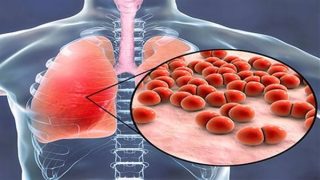 طرق فعّالة للوقاية من الالتهاب الرئوي